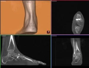 Weight Bearing CT scan. (Top Left) straight subtalar alignment. (Top right) Anteroposterior view shows navicular bone stock. (Bottom left) Sagittal slice shows features of subtalar varus, superior talonavicular arthritis. (Bottom right) straight subtalar alignment. Source: Foot & Ankle Specialist. 