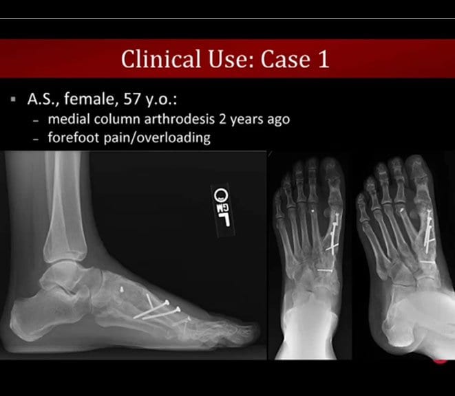 Literature Review And Case Studies From CurveBeam s Weight Bearing CT 