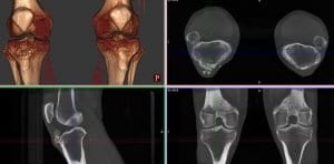 bilateral knee