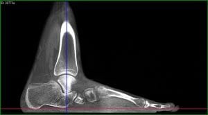 Weight bearing CT image acquired via CurveBeam pedCAT. The pedCAT has the largest field of view in its class, allowing for an entire adult foot or feet to be captured in a single scan.