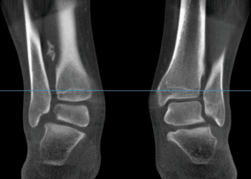 The Weight-Bearing CT International Study Group, Brought to You by CurveBeam