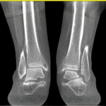 Subtle sub-fibular impingement