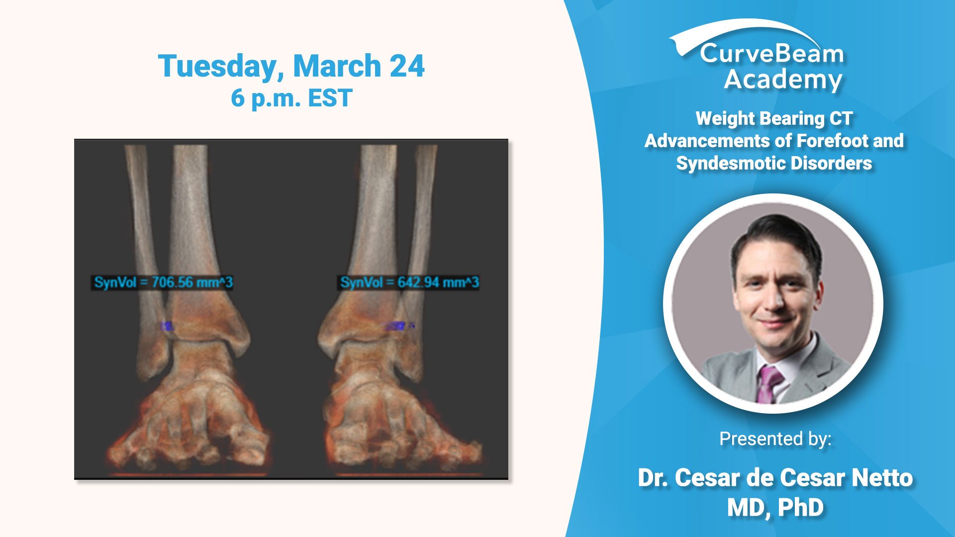 Virtual Lecture: Weight Bearing CT Advancements of Syndesmotic Disorders