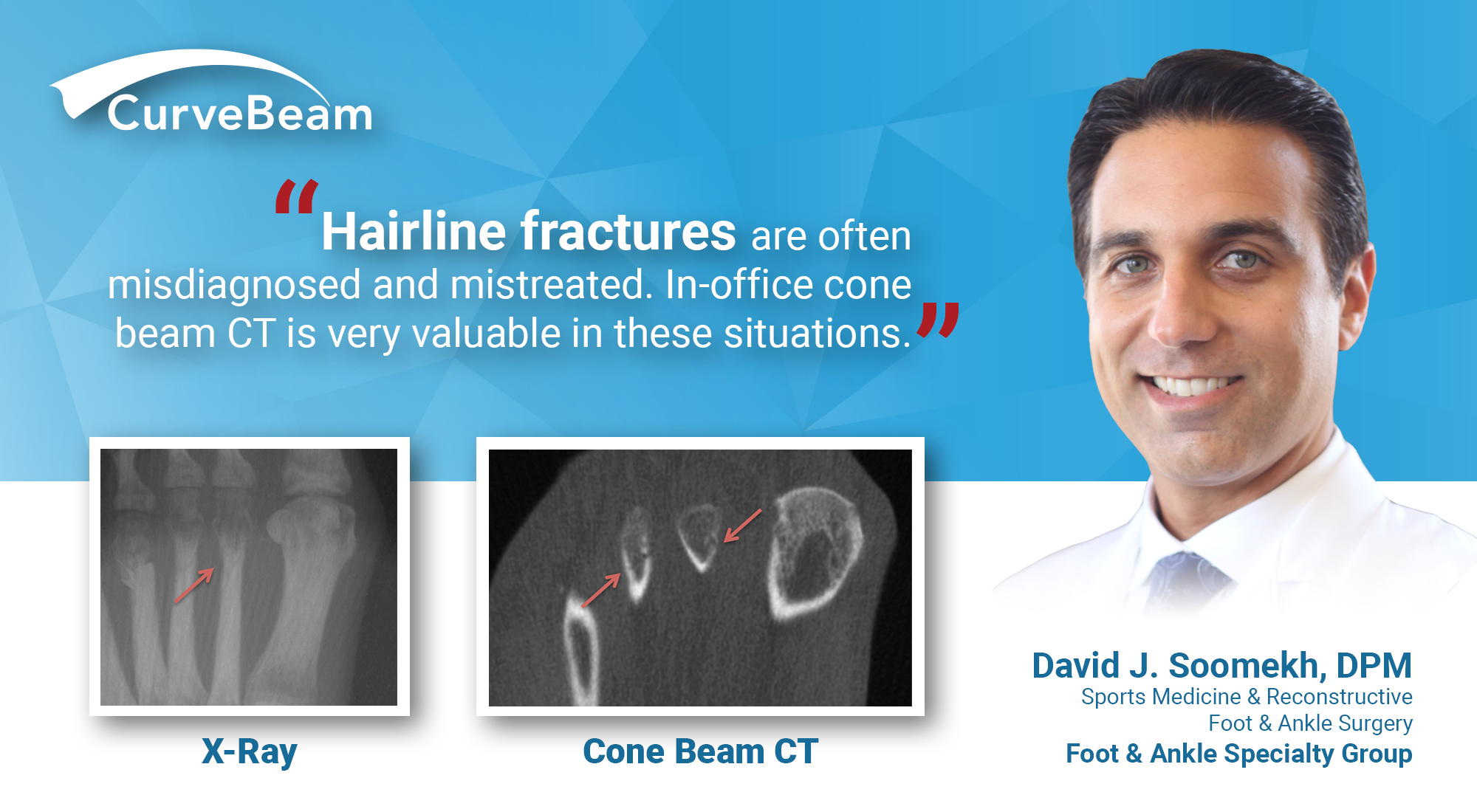 Hairline Fractures: Dx w/ In-Office CT Imaging - CurveBeam AI