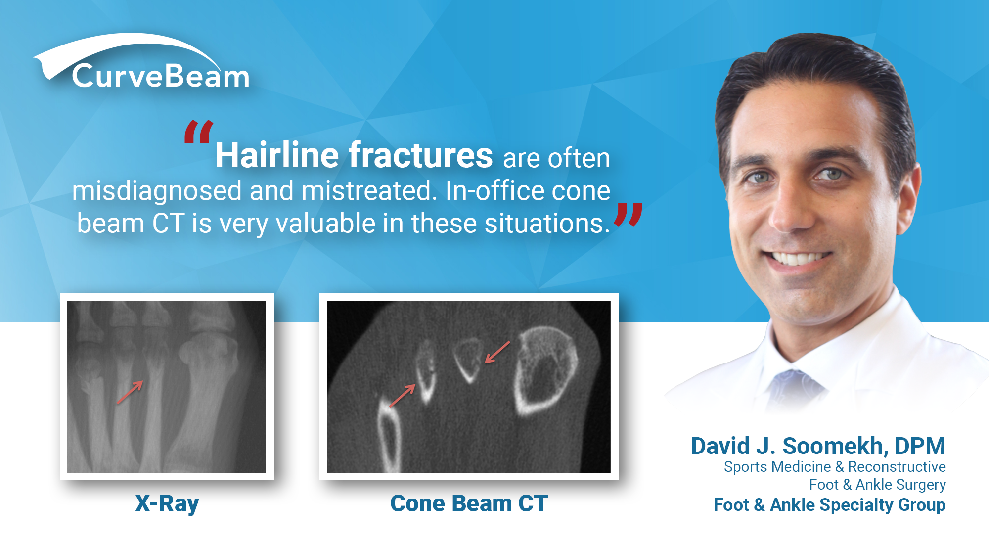 Overview of Fractures  Injuries and Poisoning  MSD Manual Consumer Version