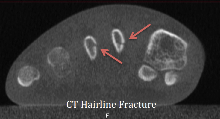 Hairline Fractures Dx W In Office Ct Imaging Curvebeam Ai 6970