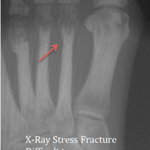 Plain X-Ray Hairline fracture