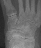 X-Ray midfoot arthritis