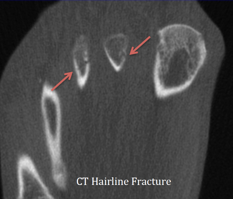 Hairline Fracture Wrist