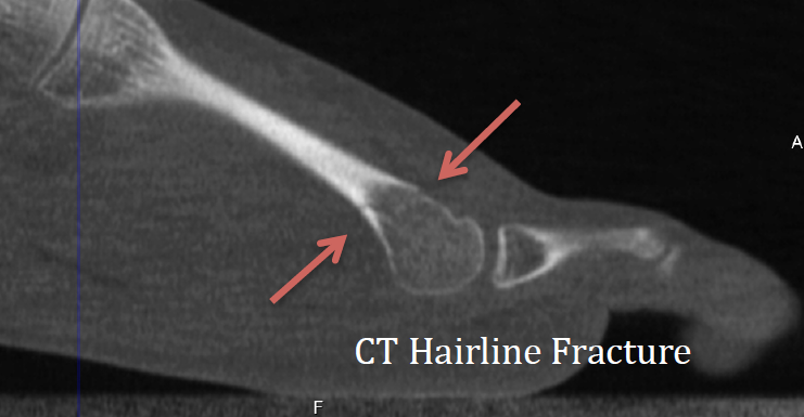 Hairline Bone Fracture  Clinicians Brief