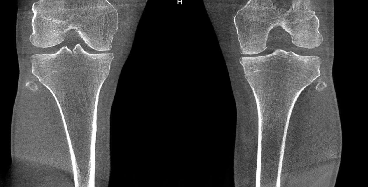 bilateral knee scan 2