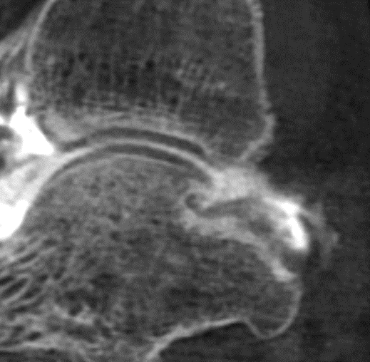 CBCT Opacified OCD Lesion