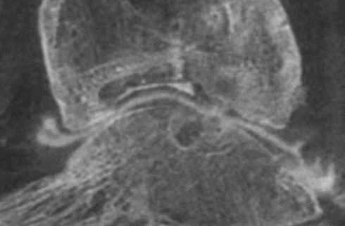 CBCT Post OA cartilage lesions cysts