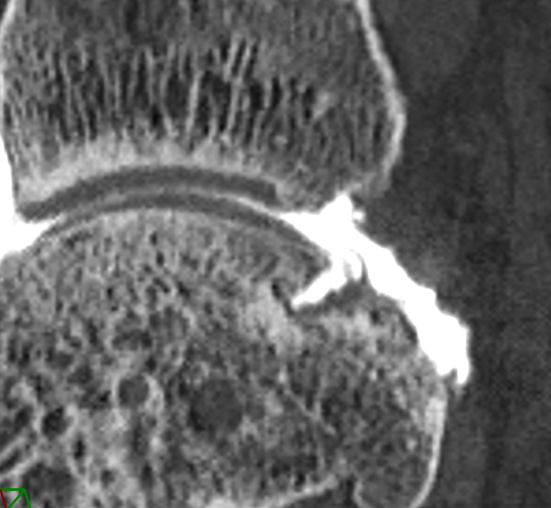 CT Opacified OCD Lesion