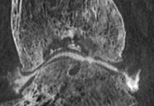 CT Post OA cartilage lesions cysts