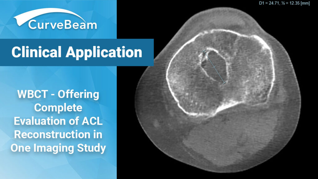 How To Get a Complete Evaluation of ACL Reconstruction in One Imaging ...