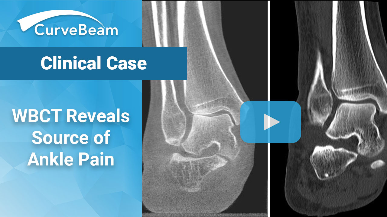 Case: WBCT Helps Diagnose Source of Ankle Pain