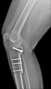 symphytum dosage for broken bones