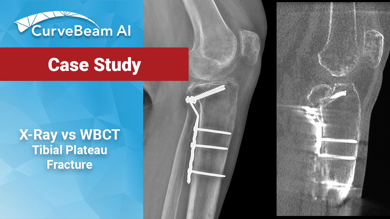 tibial condyle fracture