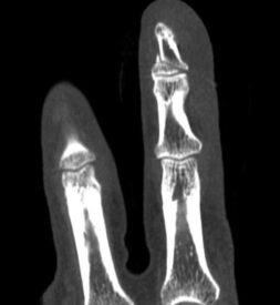 Distal Phalanx Fracture