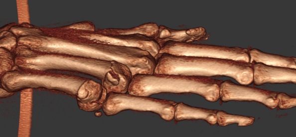 Metacarpal Fractures