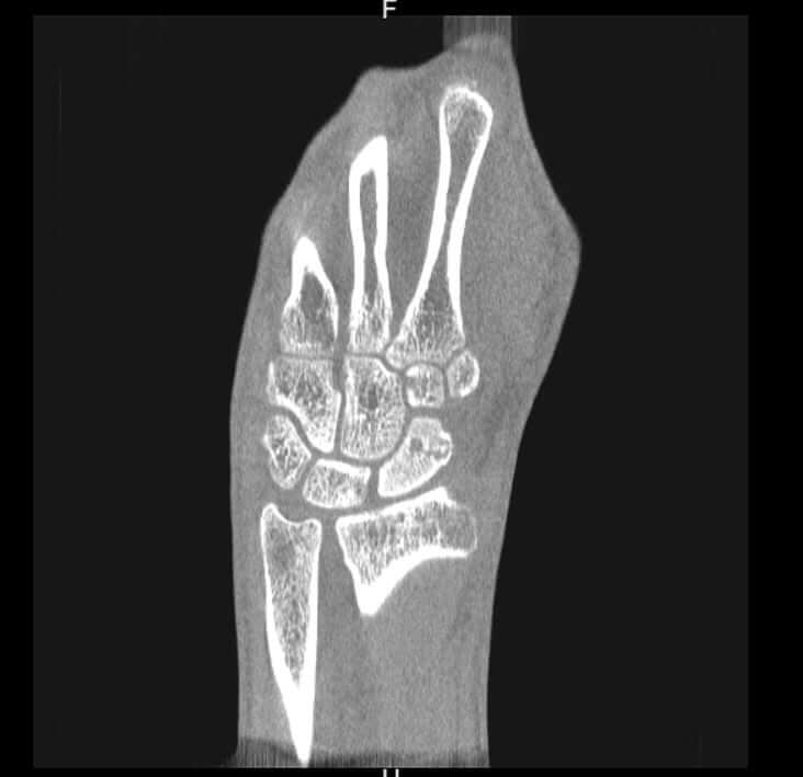 Nondisplaced Scaphoid Fracture