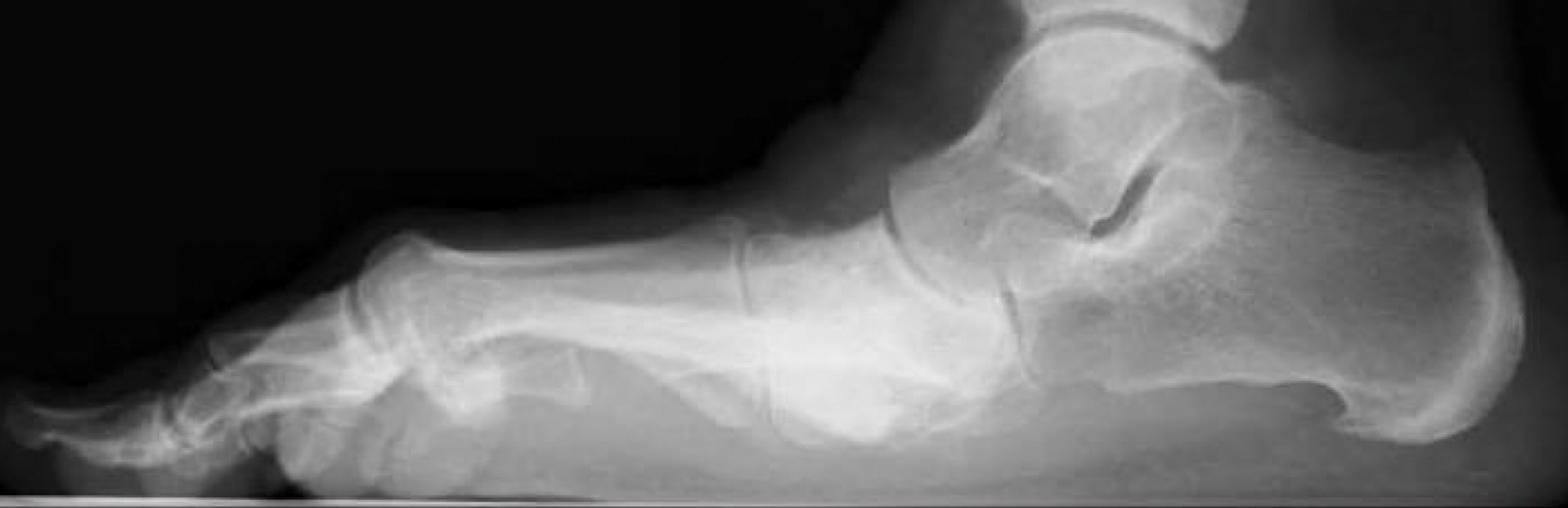 WBCT Indications Series Midfoot Arthritis CurveBeam AI