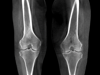 Enhanced HiRise Knee – Coronal