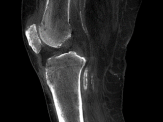 Enhanced HiRise Knee – Sagittal