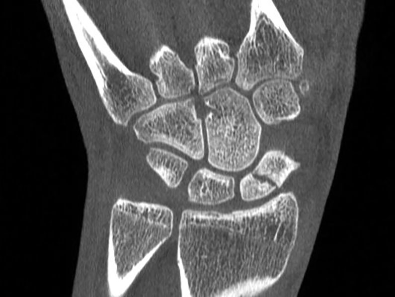 Extremity CT Imaging for Orthopedics - CurveBeam AI