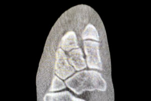 Lisfranc