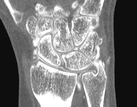 TFCC Tear 1 -arthrogram – contrast