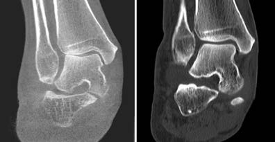 mHiRise34 – HiRise Indications Orthopedics Flyer Rev C Hip Knee