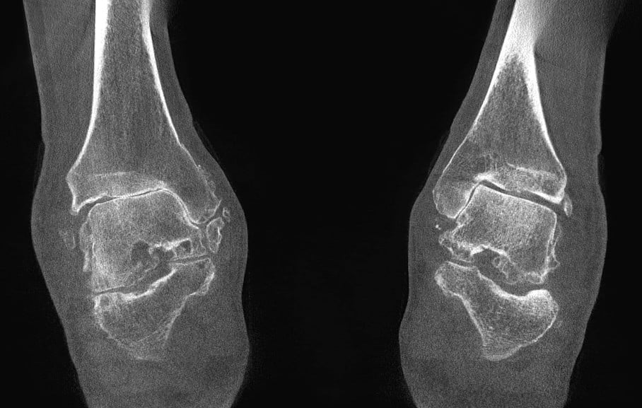 Bilateral Arthritic Ankles